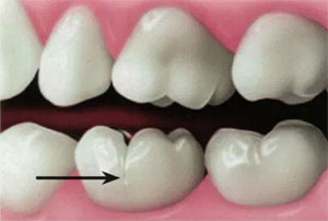Cracked Tooth 1 Cracked Tooth 1