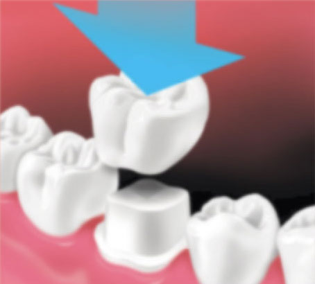 Crown-Placement1 Crown-Placement1