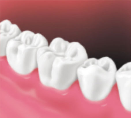 Crown-Placement2 Crown-Placement2