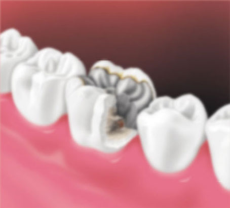 Crown-Placement Crown-Placement
