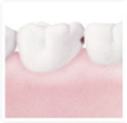 Decay in between teeth Decay in between teeth