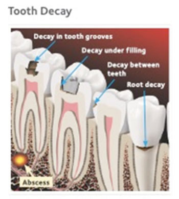 Decay in Teeth Decay in Teeth