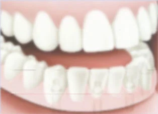 Denture-fitted-over-implants Denture-fitted-over-implants