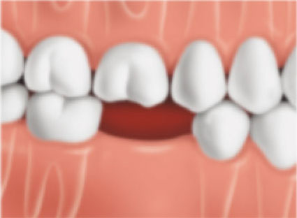 Drifting-Teeth1 Drifting-Teeth1