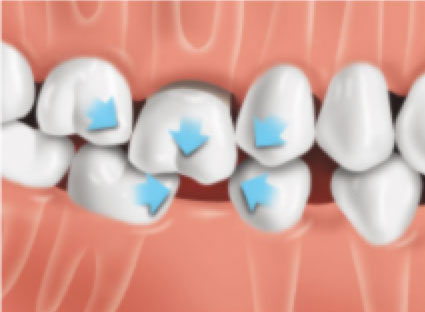 Drifting-Teeth2 Drifting-Teeth2