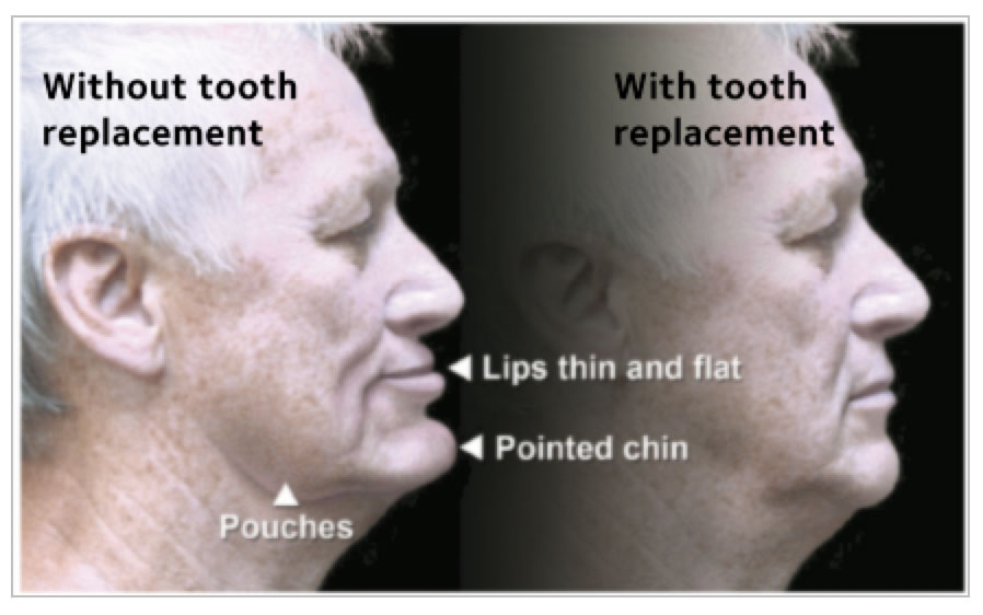 Facial-Collapse Facial-Collapse