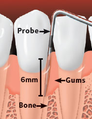 Flap-and-Osseous-1 Flap-and-Osseous-1
