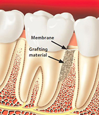 Grafting-Material-1 Grafting-Material-1