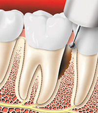 Guided Tissue 1 Guided Tissue 1