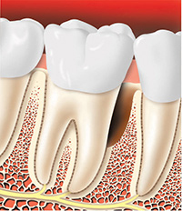 Guided Tissue 2 Guided Tissue 2