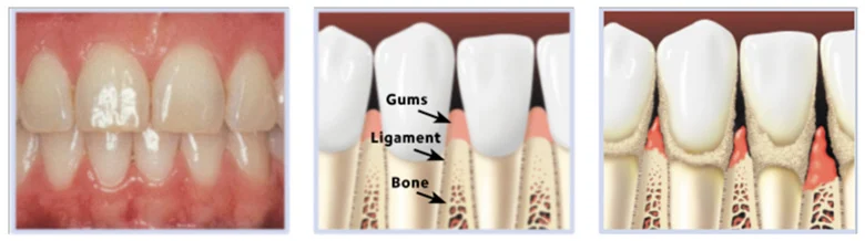 Gum Disease Gum Disease