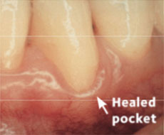 Healed Pocket Healed Pocket