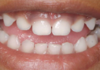 Healthy baby teeth Healthy baby teeth