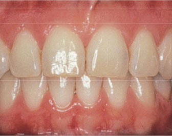Healthy Gum 1 Healthy Gum 1