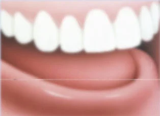 Implant-Dentures Implant-Dentures