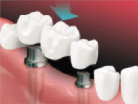 Implant-Supported-Bridge1 Implant-Supported-Bridge1