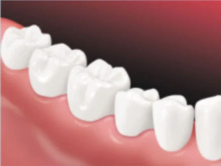 Implant-Supported-Bridge2 Implant-Supported-Bridge2