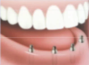 Implants-in-the-jaw Implants-in-the-jaw