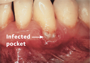 Infected Pocket Infected Pocket
