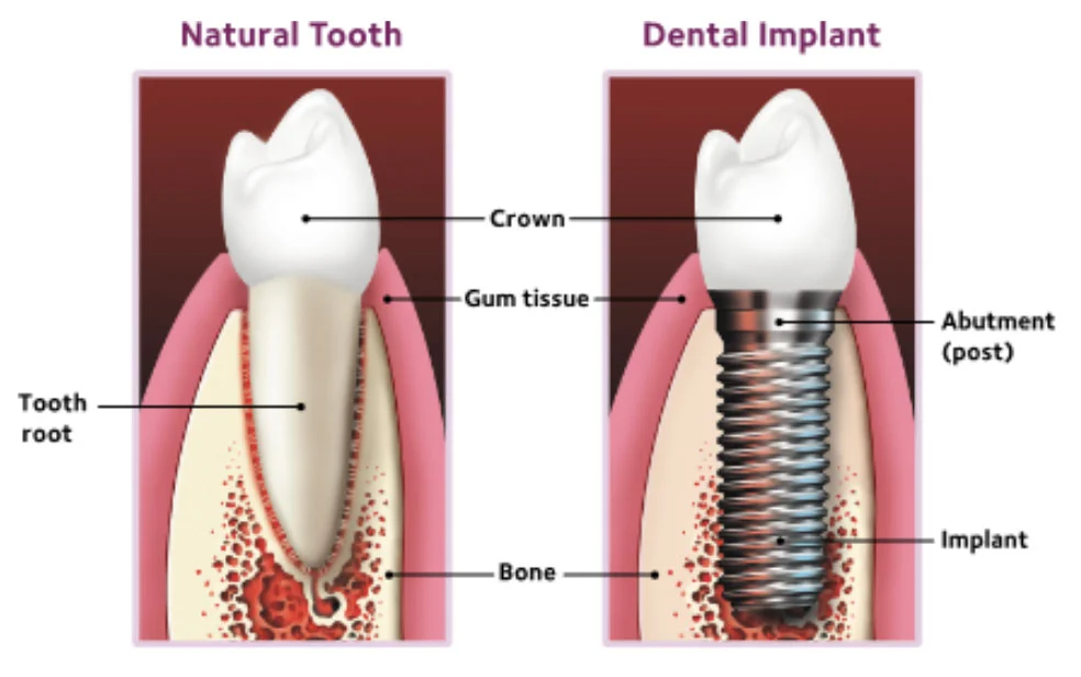 Natural-Dental-Teeth Natural-Dental-Teeth