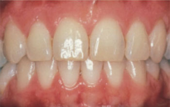 Normal-Healthy-Gum Normal-Healthy-Gum
