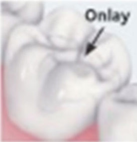 Onlay Onlay