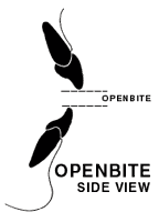 Open Bite Open Bite
