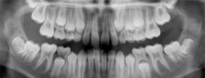 Panoramic x-ray Panoramic x-ray