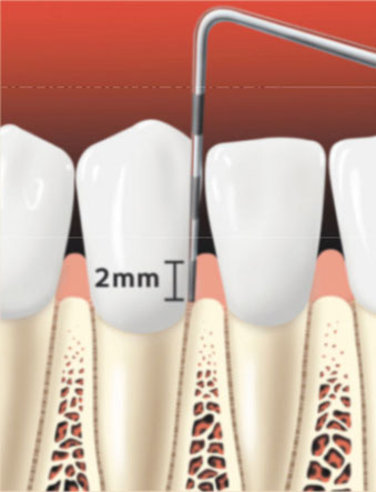 Periodontal Probe 1 Periodontal Probe 1