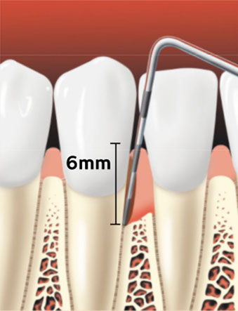 Periodontal Probe 2 Periodontal Probe 2