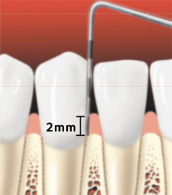 Periodontal-Probe-of-Healthy-Gums Periodontal-Probe-of-Healthy-Gums
