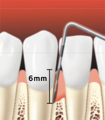 Periodontal-Probe-Showing-a-Pocket Periodontal-Probe-Showing-a-Pocket