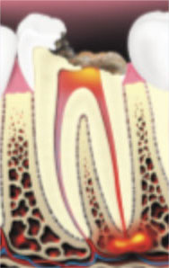 Root-Canal-Therapy1 Root-Canal-Therapy1