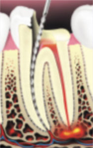 Root-Canal-Therapy2 Root-Canal-Therapy2