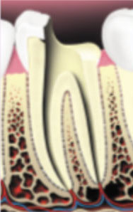 Root-Canal-Therapy3 Root-Canal-Therapy3