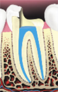 Root-Canal-Therapy4 Root-Canal-Therapy4