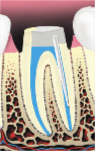 Root-Canal-Therapy5 Root-Canal-Therapy5