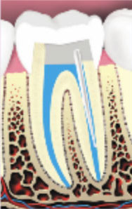 Root-Canal-Therapy6 Root-Canal-Therapy6
