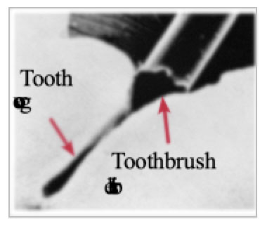 Tooth Decay Tooth Decay