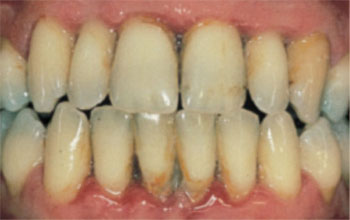 Severe-Periodontal-Disease Severe-Periodontal-Disease