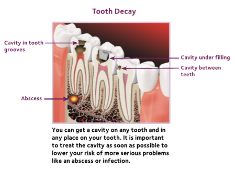 Tooth Decay Tooth Decay